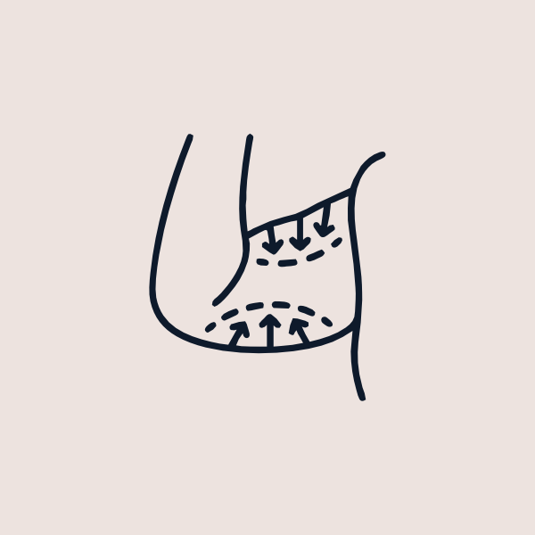 Arm Lift